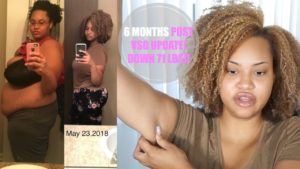 Read more about the article 6 MTH VSG WEIGHT LOSS UPDATE: HIGH PROTEIN DIET, HAIR SHEDDING, LOOSE SKIN?! BEFORE & AFTER PICS!